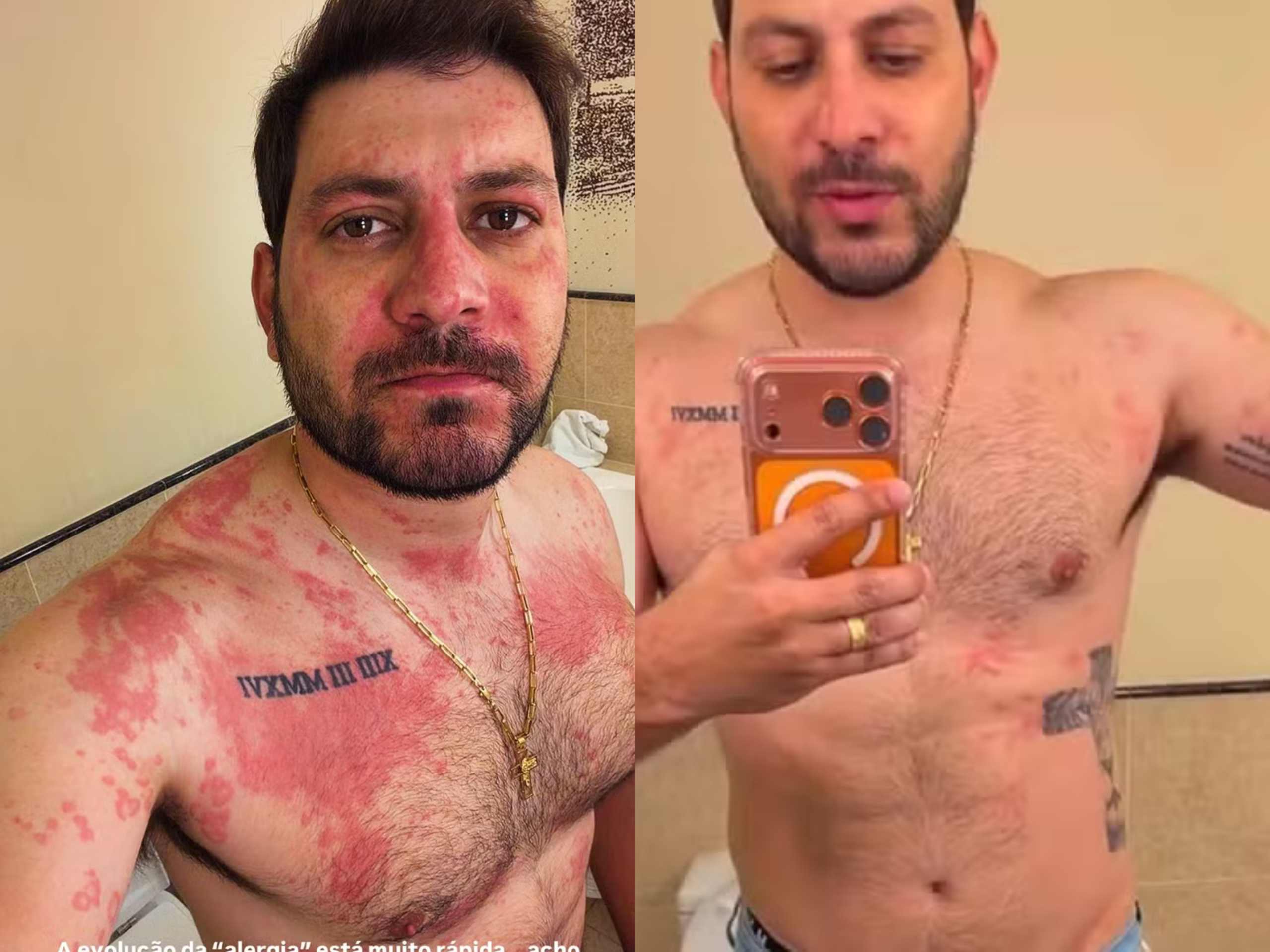 Ex-BBB Caio Afiune assusta fãs após reação alérgica intensa e ida ao hospital
