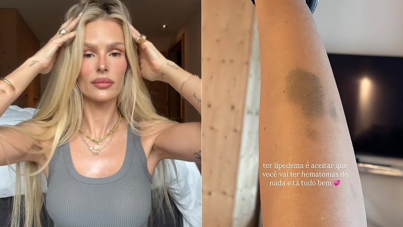 Yasmin Brunet exibe hematoma na perna e fala sobre convivência com lipedema