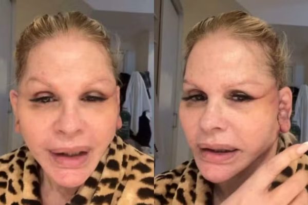 Monique Evans conta que passou por situação inusitada em banco durante recuperação de cirurgia facial