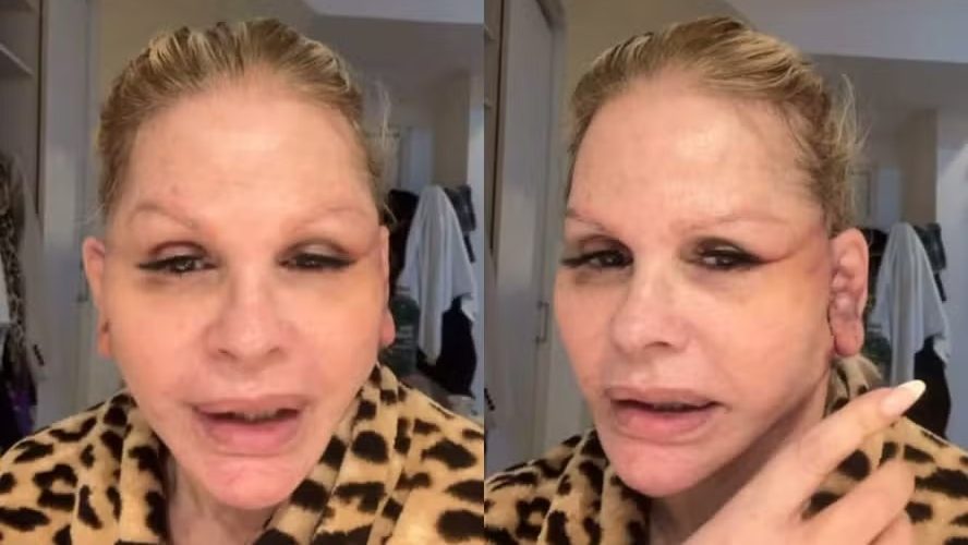 Monique Evans conta que passou por situação inusitada em banco durante recuperação de cirurgia facial