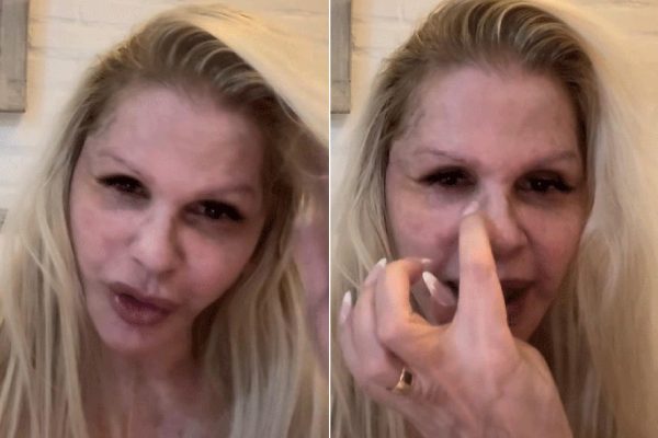 Monique Evans comemora evolução do rosto sete dias após cirurgia plástica