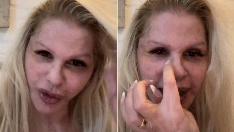 Monique Evans comemora evolução do rosto sete dias após cirurgia plástica