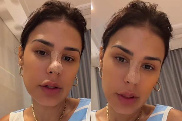 Simone Mendes revela procedimento no nariz após aparecer com curativo e brinca com surpresa dos fãs