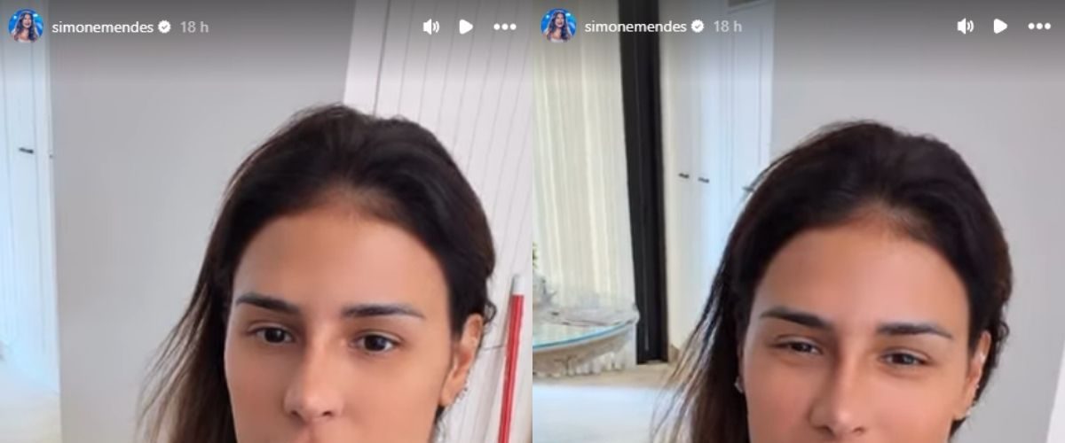 Simone Mendes surge sem curativos e revela como ficou o nariz após procedimento